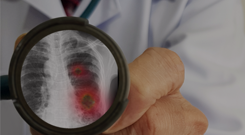 Causas y factores de riesgo en el cáncer de pulmón