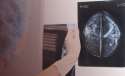 Diagnóstico y síntomas del cáncer de mama metastásico
